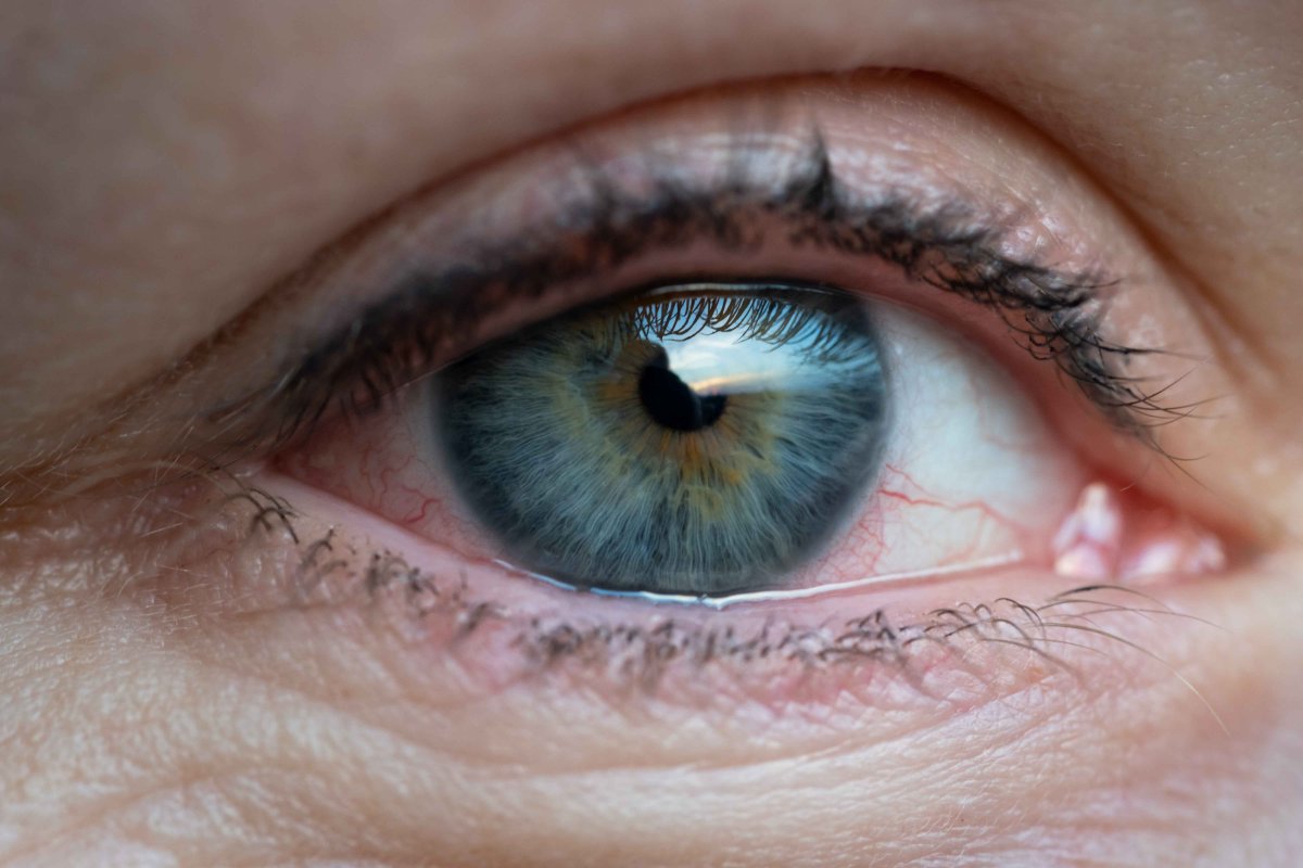 Kuru göz sendromu neden oluşur ve nasıl tedavi edilir #4